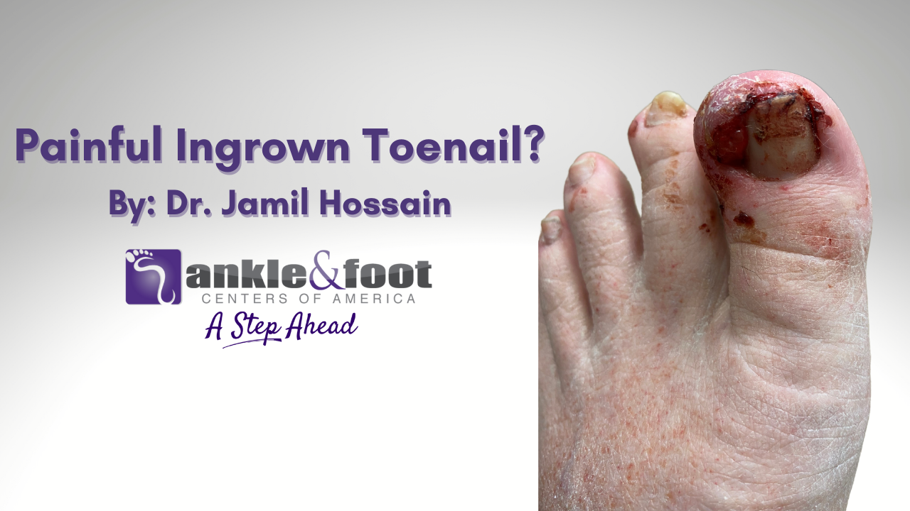 Painful Ingrown Toenails? Our Franklin Foot & Ankle Doctor, Dr. Jamil Hossain educates Tennessee Patients