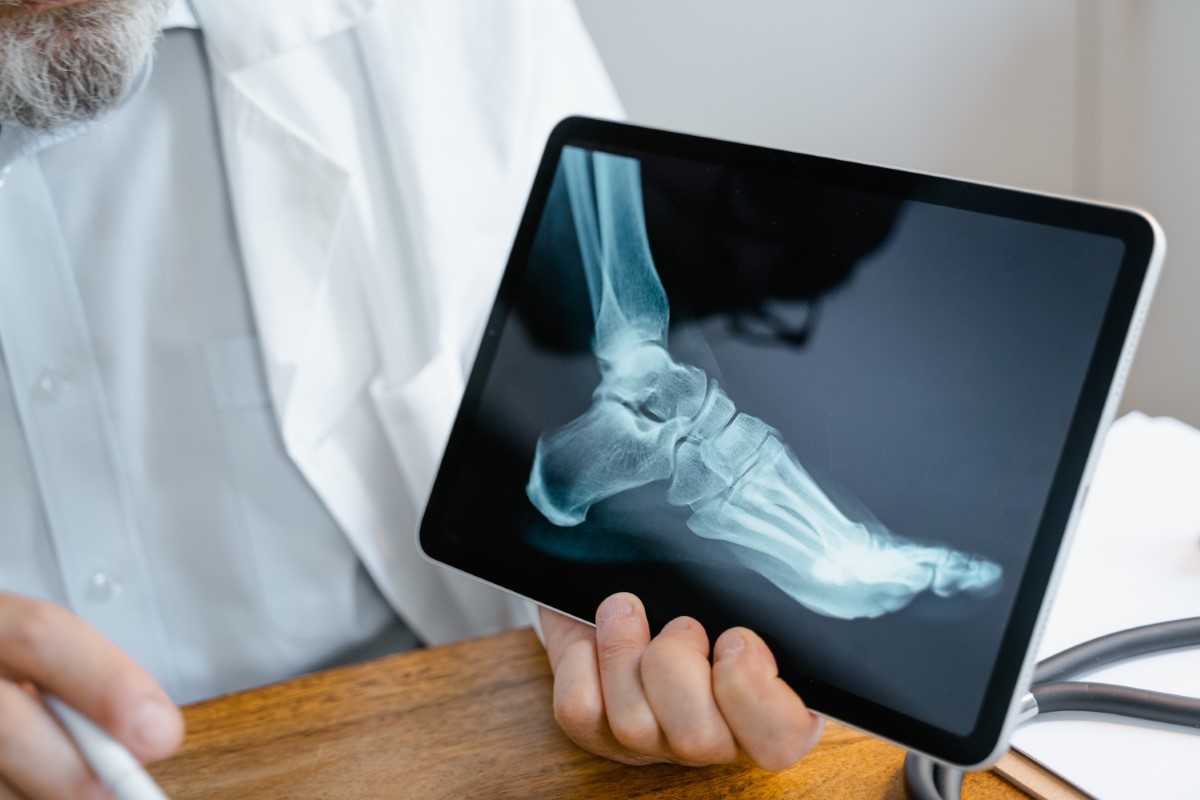 Ankle & Foot Centers Of America Tennessee Hammertoe Surgery