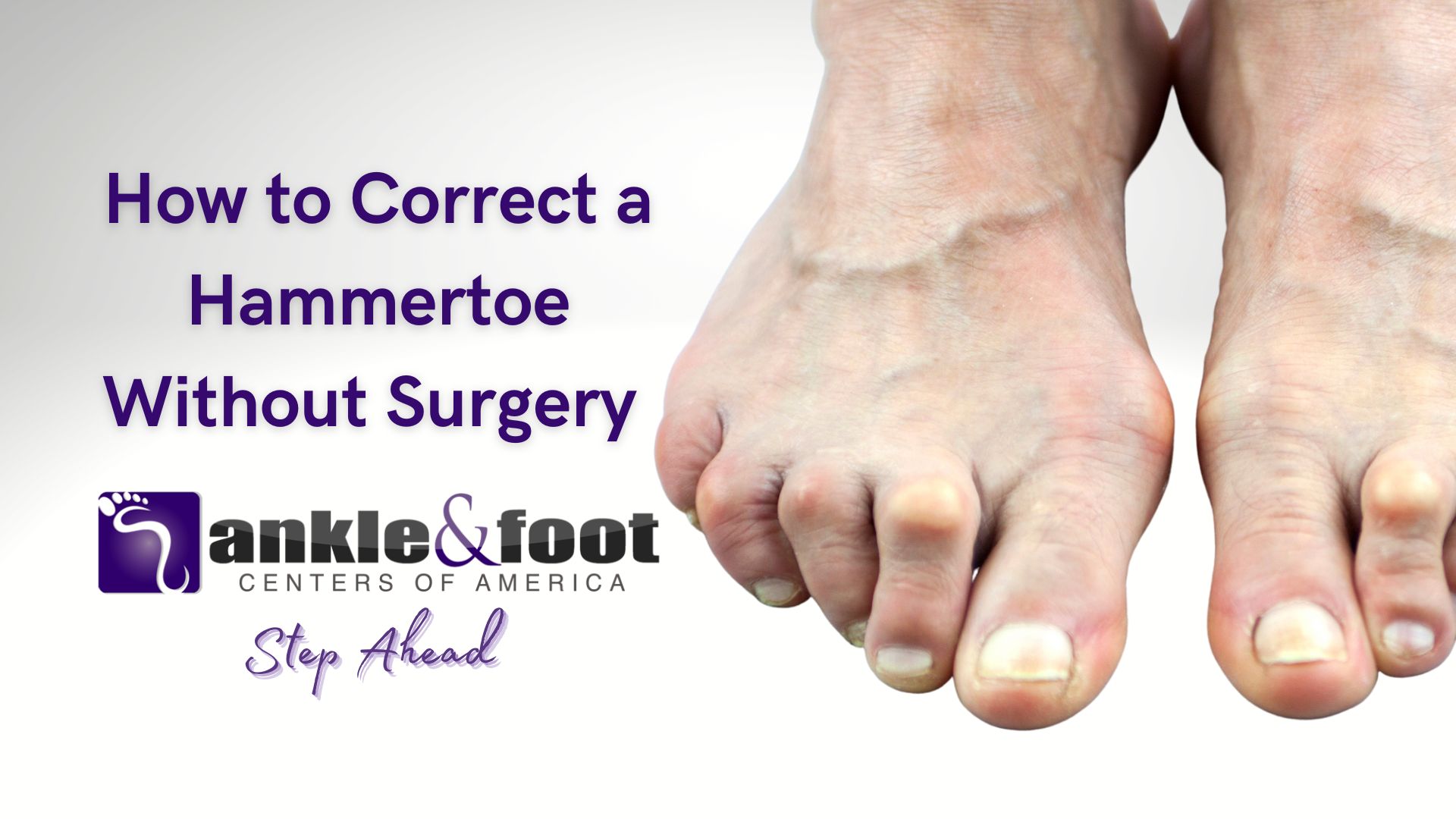 Non-Surgical Treatment for Hammertoe