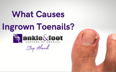 How to Get Rid of an Ingrown Toenail Permanently?