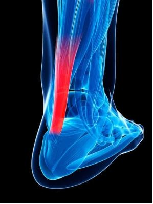 Achilles Tendinitis Treatment in Nashville Tennessee