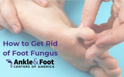 How to Get Rid of Athlete’s Foot
