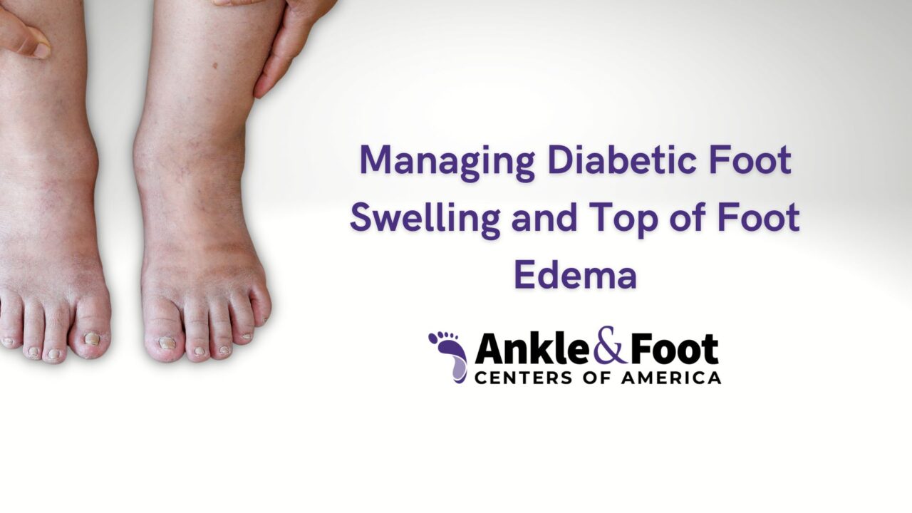 Diabetic Foot Swelling 