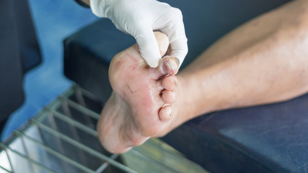 Diabetic Foot Ulcer Treatment & Prevention - What to Know!