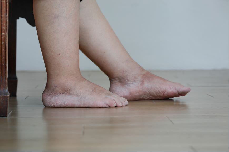 Diabetic Foot Swelling 