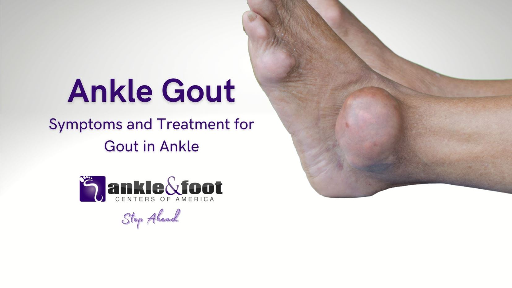 Gout in Ankle Symptoms