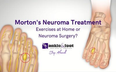 Morton’s Neuroma Specialist in Nashville, Tennessee