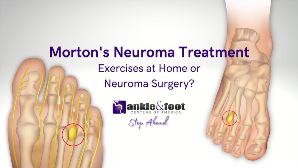 Morton's Neuroma Specialist in Nashville, Tennessee