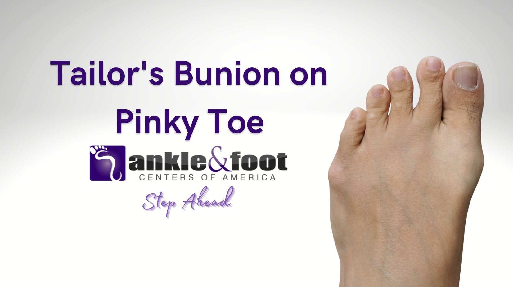 Tailor's Bunion on Pinky Toe