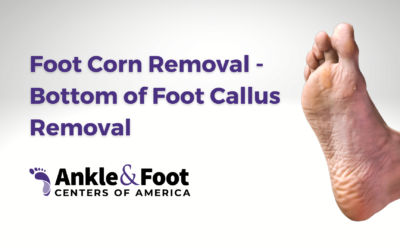 Foot Corn Removal: A Comprehensive Guide