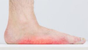 Pediatric Flat Feet