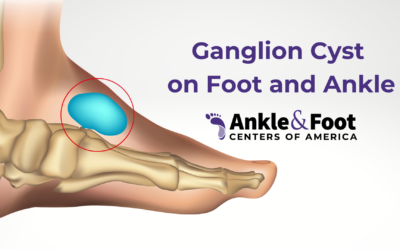 Treating a Ganglion Foot Cyst in Nashville
