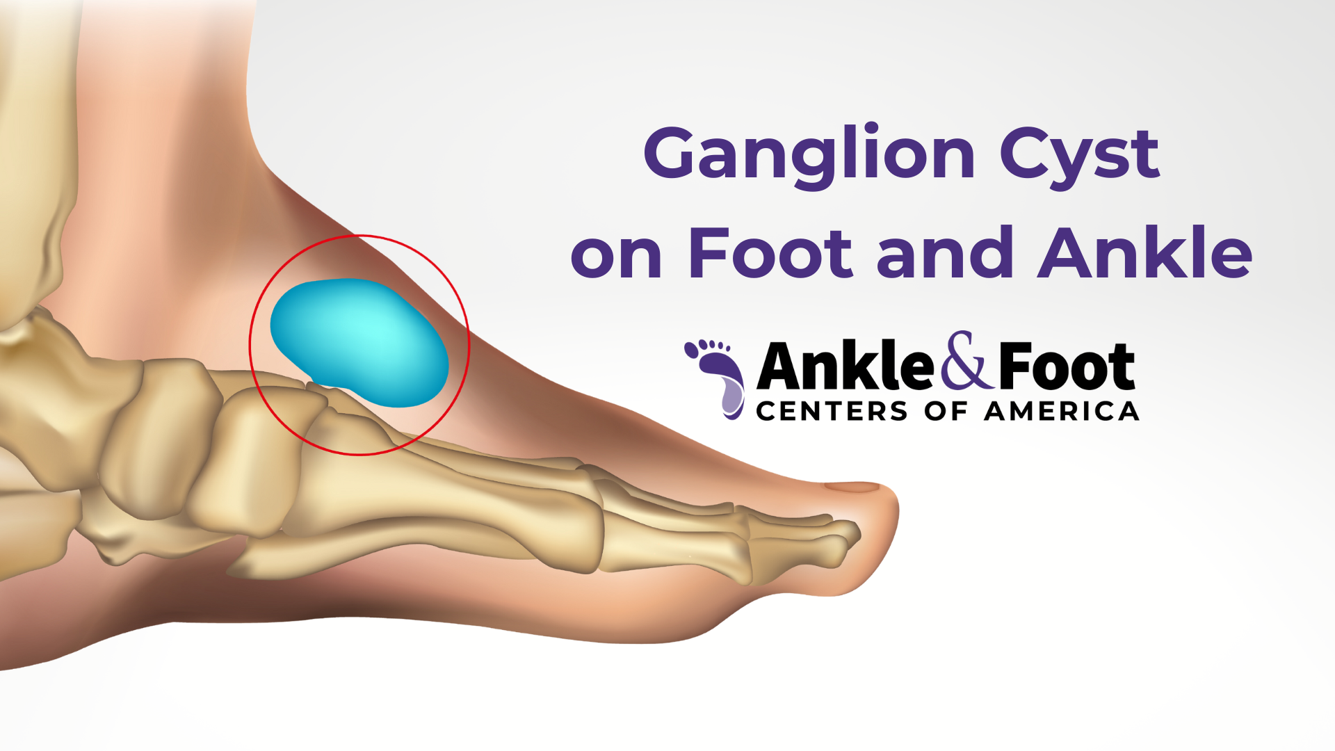 Ganglion Foot Cyst Nashville